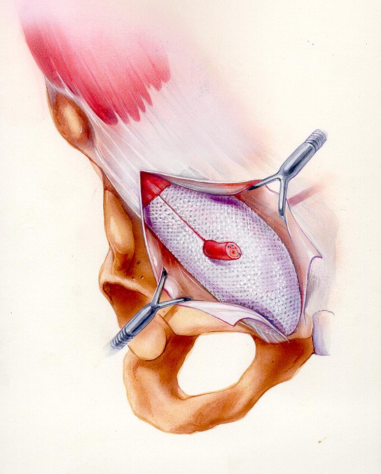 Trabucco hernia